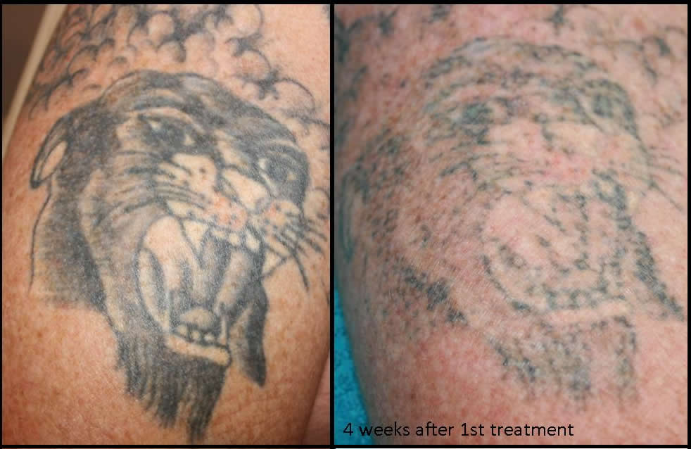 Tattoo Removal Exhale Body Rejuvenation