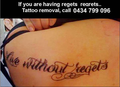 Tattoo Removal