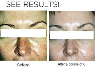 Exhale Body Rejuvenation - Chemical Peel Results